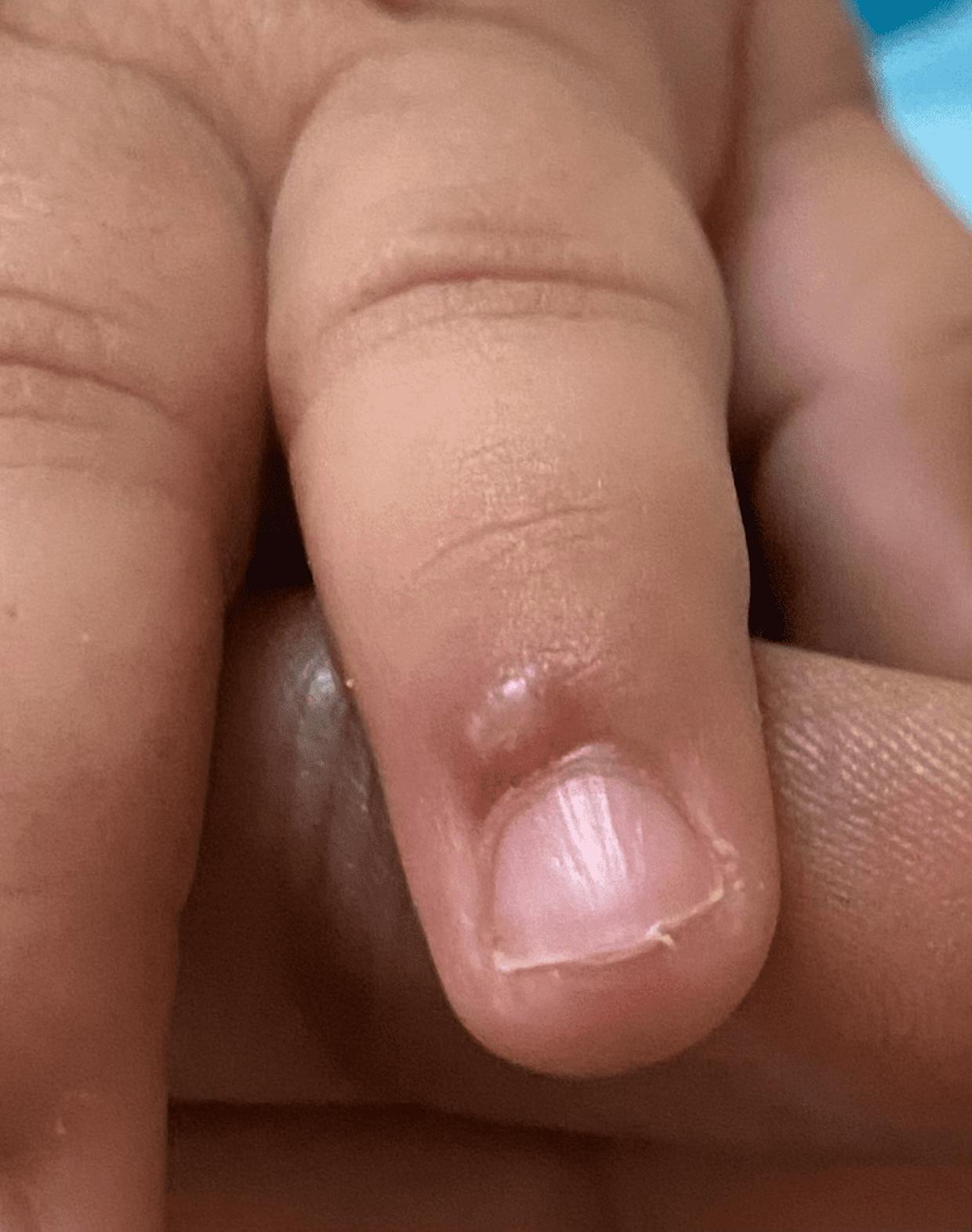 My baby is 5mo boy.. ebf.. at the start of nails he used to have small tiny  boils since more than a month.. my Doc had said it's nothing to worry  about..