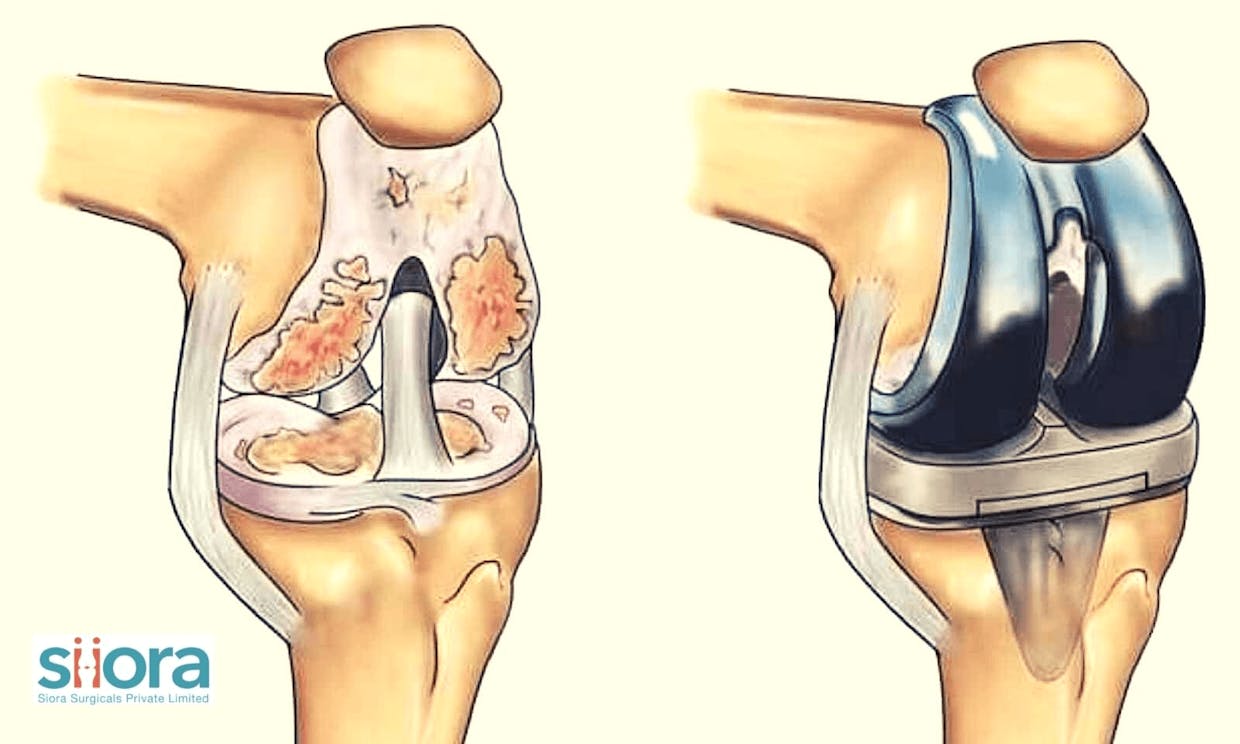 Joint Replacement Surgery