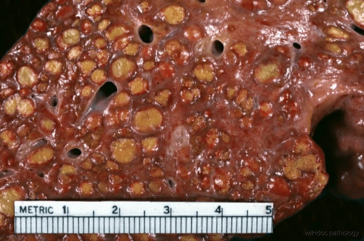 Gross pathology of diffuse macrolobular cirrhosis in the liver at autopsy (